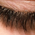 How do you know if you have lash mites?