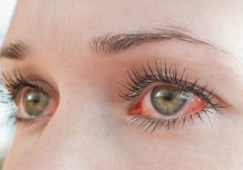 What do i do if i have an allergic reaction to eyelash extensions?