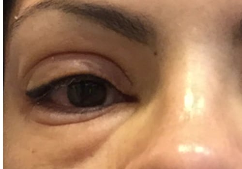 Do eyelash extensions cause long term damage?