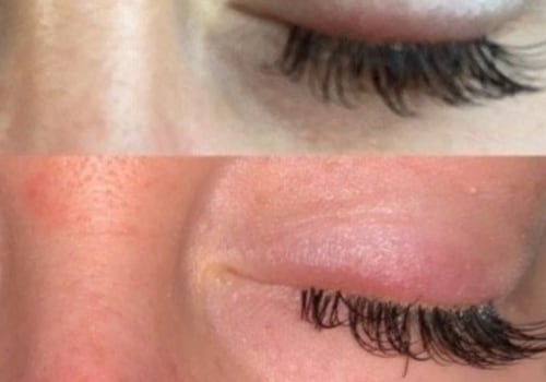 How do you treat an allergic reaction to eyelash extensions?
