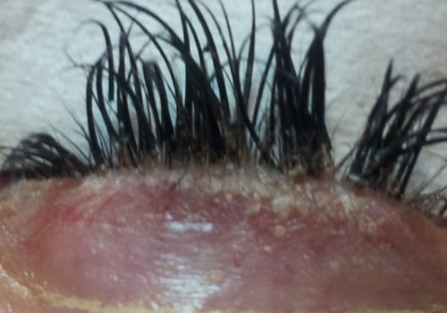 Who is not suitable for eyelash extensions?